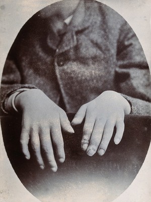 view The hands of a child, showing deformity, particularly around the fingertips. Photograph by N. Goulton May.