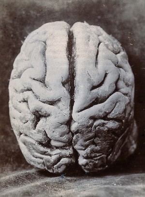 view A brain, viewed from the top, supposedly from a subject with mental deficiency. Photograph by N. Goulton May.