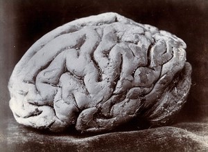 view A brain, viewed from the side, supposedly from a subject with mental deficiency. Photograph by N. Goulton May.