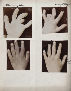 Down's syndrome affecting the hands and fingers. Four photographs.