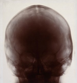 view X-ray photograph of a skull, probably from a person with Down's syndrome. Photograph by Finzi, 1913.