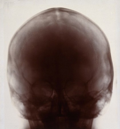 X-ray photograph of a skull, probably from a person with Down's syndrome. Photograph by Finzi, 1913.