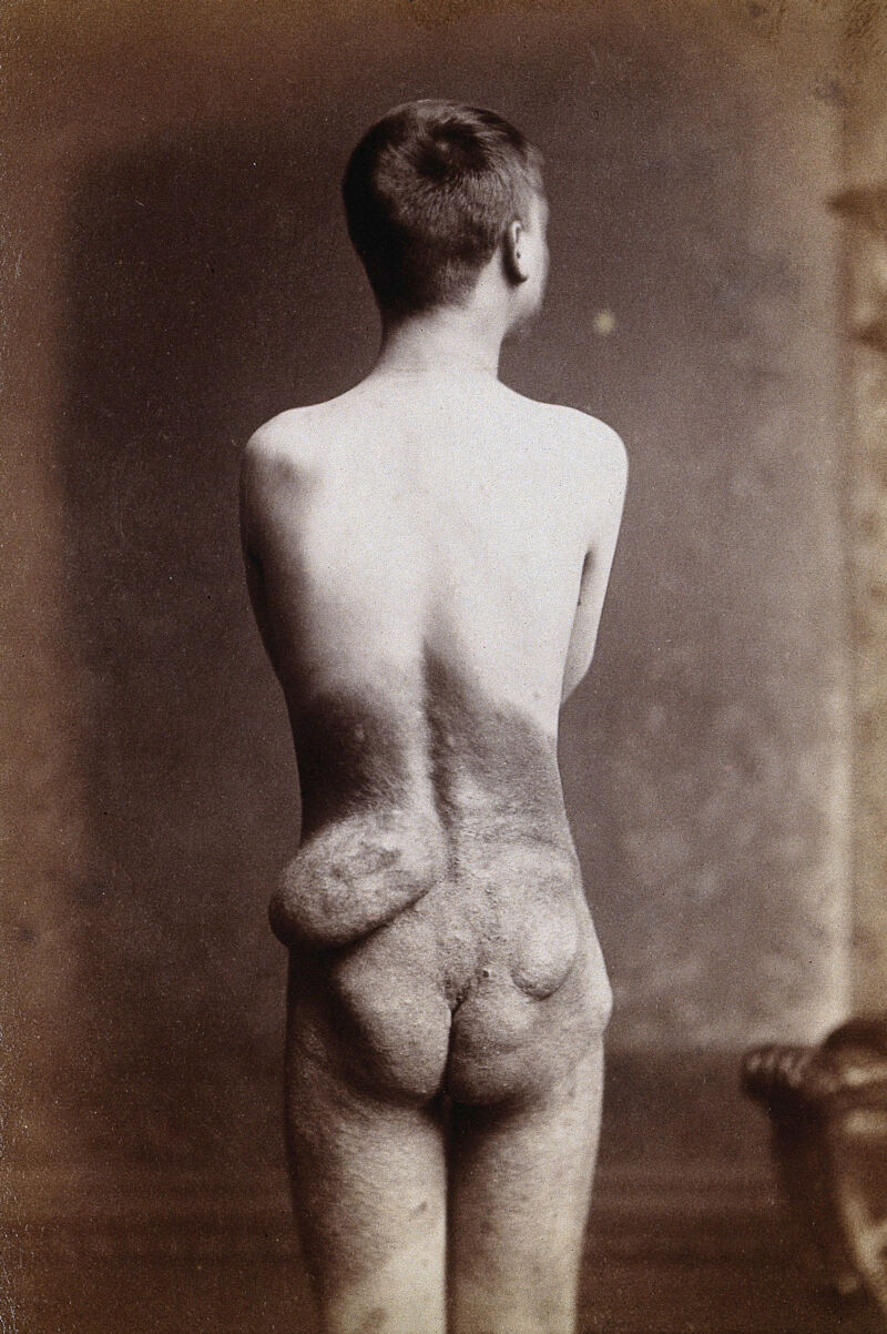 A naked young man, viewed from the back, showing signs of skin disease and  tumours. Process print. | Wellcome Collection