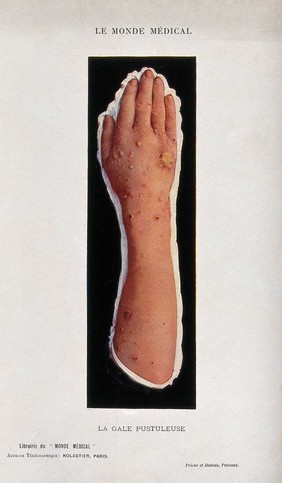 Hand and arm infected with scabies. Process print.