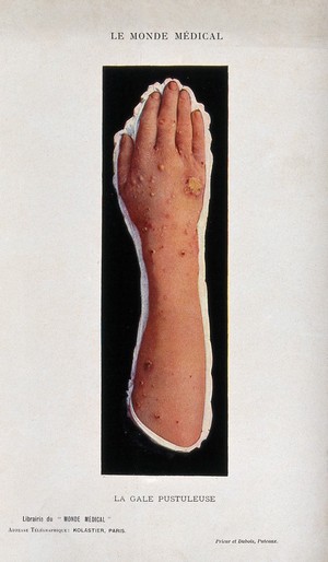 view Hand and arm infected with scabies. Process print.