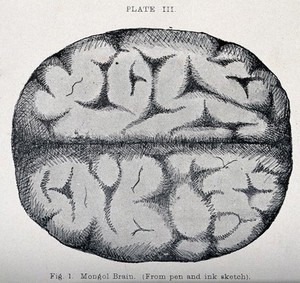 view Brain of a person with Down's syndrome. Process print.