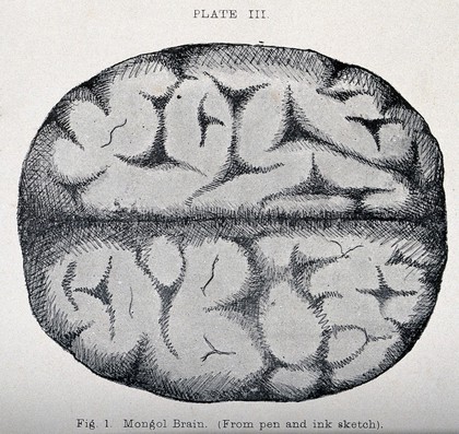 Brain of a person with Down's syndrome. Process print.