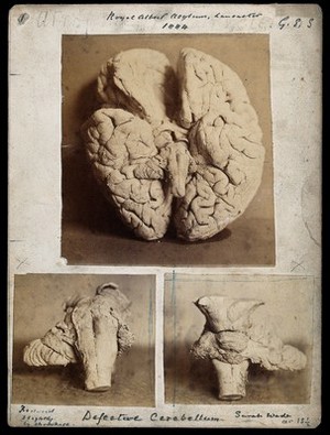 view Royal Albert Asylum, Lancaster: brain with a defective cerebellum, seen from different angles. Three photographs, 1884.