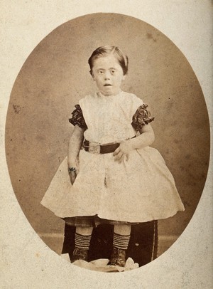 view A girl with Down's syndrome, sitting, wearing striped socks. Photograph by J.A.Baldry.