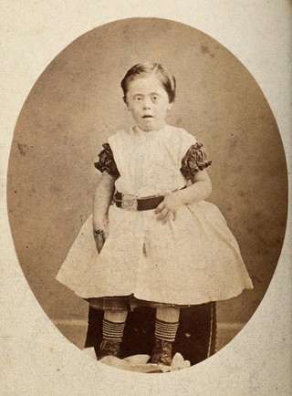 A girl with Down's syndrome, sitting, wearing striped socks. Photograph by J.A.Baldry.