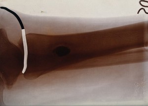 view X-ray of a leg (shinbone ?). Photograph, ca. 1900.