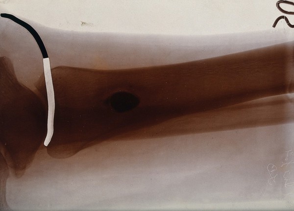 X-ray of a leg (shinbone ?). Photograph, ca. 1900.