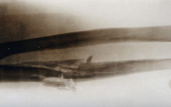 X-ray (of an arm ?), showing a broken bone. Photograph, ca. 1915.