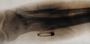 view X-ray of a leg, showing a safety pin and a broken fibula. Photograph, ca. 1915.