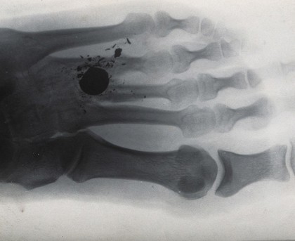 X-ray of a hand or foot, showing a (bullet hole ?) between the third and fourth digits. Photograph, ca. 1915.