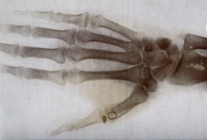 view X-ray of a hand, showing damage to the thumb. Photograph, ca. 1915.