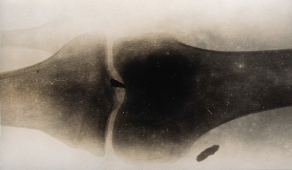 X-ray of a knee or elbow joint, showing matter (shrapnel ?) in the tissue. Photograph, ca. 1915.