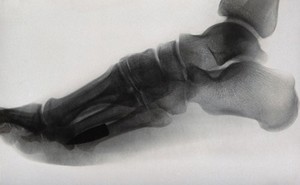 view X-ray of a foot, showing a bullet. Photograph, ca. 1915.