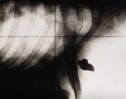 X-ray of a rib-cage (?), showing matter (shrapnel ?). Photograph, ca. 1915.