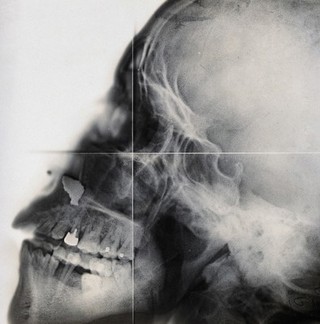 X-ray of a skull, in profile. Photograph, ca. 1915.