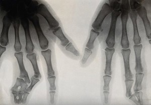 view X-ray of a pair of hands with damaged fingers. Photograph, ca. 1915.