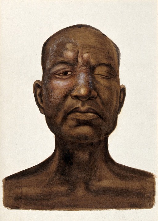 Leprosy of the face: head and shoulders portrait of an Indian man with one eye closed. Watercolour (by Jane Jackson ?), 1921/1950 (?), after a (painting ?) by Ernest Muir, ca. 1921.