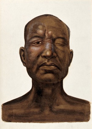 view Leprosy of the face: head and shoulders portrait of an Indian man with one eye closed. Watercolour (by Jane Jackson ?), 1921/1950 (?), after a (painting ?) by Ernest Muir, ca. 1921.