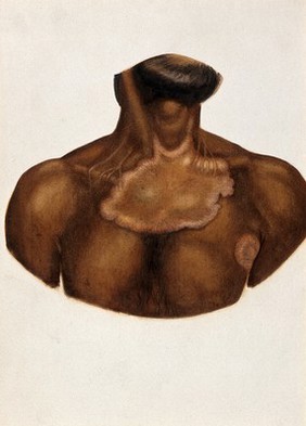 Leprosy of the chest on an Indian man. Watercolour (by Jane Jackson ?), 1921/1950 (?), after a (painting ?) by Ernest Muir, ca. 1921.