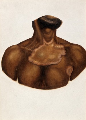 view Leprosy of the chest on an Indian man. Watercolour (by Jane Jackson ?), 1921/1950 (?), after a (painting ?) by Ernest Muir, ca. 1921.
