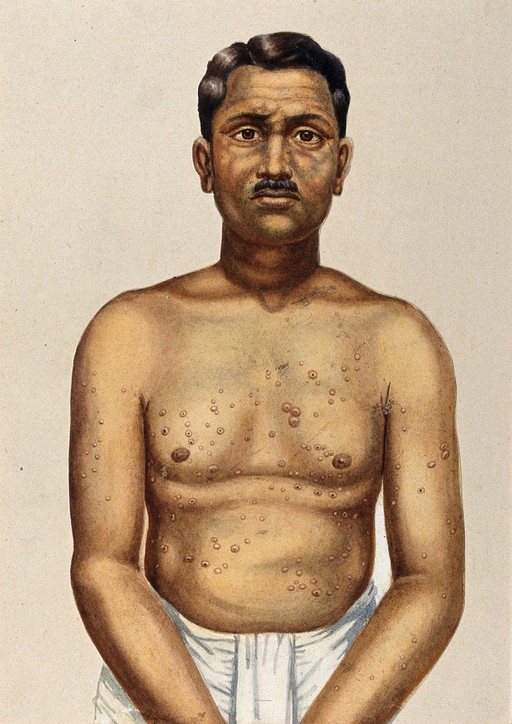 Leprosy of the skin: an Indian man with nodules on his chest and a discoloured face. Watercolour (by Jane Jackson ?), 1921/1950 (?), after a (painting ?) by Ernest Muir, ca. 1921.