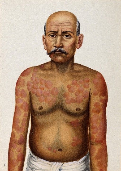 Leprosy of the skin: an Indian man with red patches on his chest. Watercolour (by Jane Jackson ?), 1921/1950 (?), after a (painting ?) by Ernest Muir, ca. 1921.