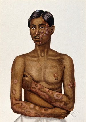 view Leprosy of the skin: an Indian man with circular patches on his face, chest and arms. Watercolour, 1921/1950 (?) by Jane Jackson, after a (painting ?) by Ernest Muir (?), ca. 1921.