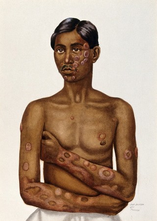 Leprosy of the skin: an Indian man with circular patches on his face, chest and arms. Watercolour, 1921/1950 (?) by Jane Jackson, after a (painting ?) by Ernest Muir (?), ca. 1921.