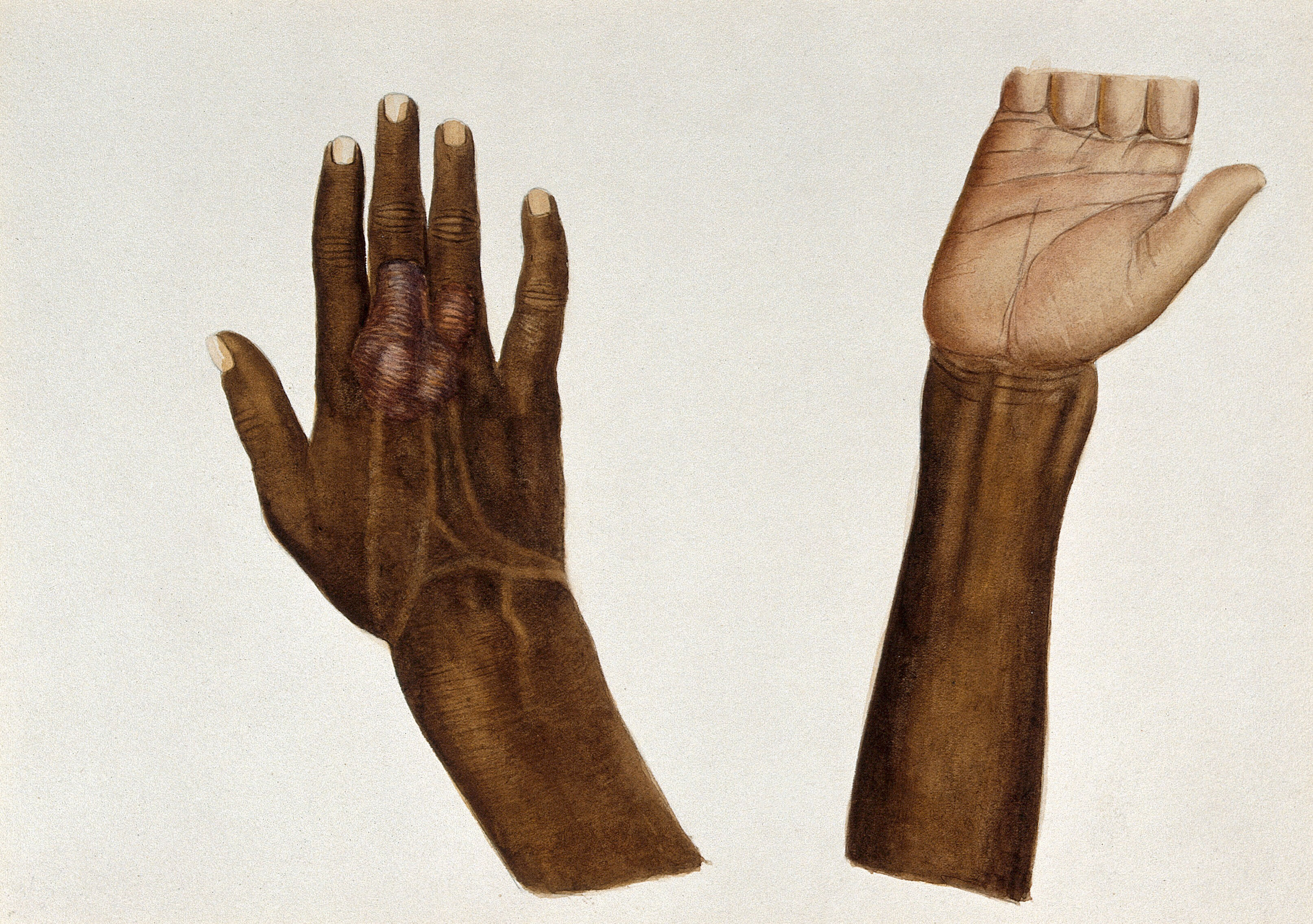 Leprosy On The Hand Of An Indian Man The Palm And Back Of An Infected Hand Watercolour By Jane Jackson 1921 1950 After A Painting By Ernest Muir Ca 1921 Wellcome Collection