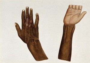 view Leprosy on the hand of an Indian man: the palm and back of an infected hand. Watercolour (by Jane Jackson ?), 1921/1950 (?), after a (painting ?) by Ernest Muir, ca. 1921.