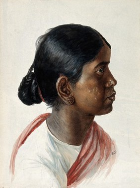 Leprosy: nodules on an Indian woman's face: a head and shoulders portrait in profile. Watercolour by E. Schwarz, 1920/1950 (?).