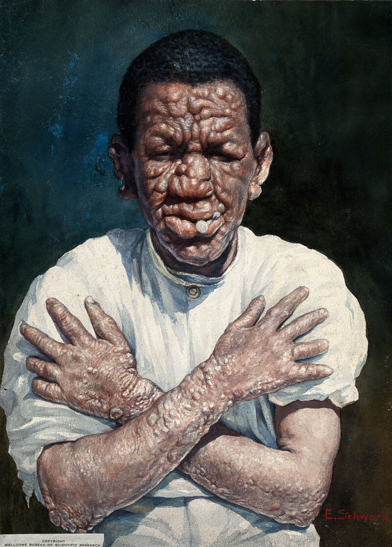 Leprosy: severe swelling on a man's face and arms. Watercolour by E