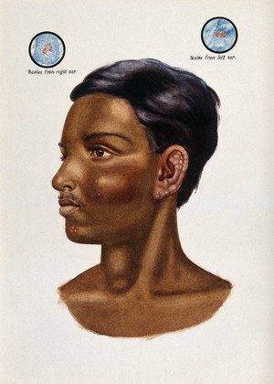 view Leprosy on the ears and face of an Indian schoolboy; circular inserts show microscopic details of scales on his ears. Watercolour (by Jane Jackson ?), 1921/1950 (?), after a (painting ?) by Ernest Muir, ca. 1921.