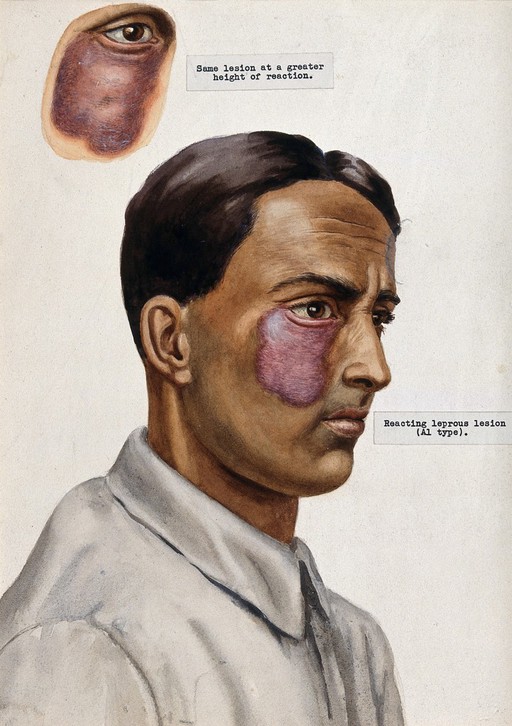Leprosy: a red lesion on the face of an Indian man; an insert shows a detail of the same lesion. Watercolour (by Jane Jackson ?), 1921/1950 (?), after a (painting ?) by Ernest Muir, ca. 1921.