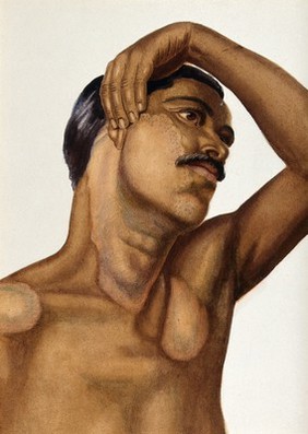 Leprosy (tuberculoid type) on the neck and chest of an Indian man. Watercolour (by Jane Jackson?), 1921/1950 (?), after Ernest Muir, ca. 1921.