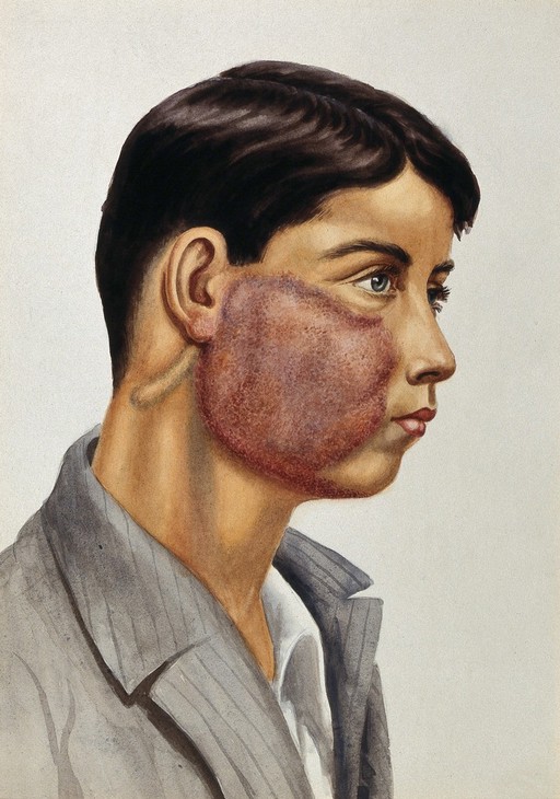 Leprosy: a raised red lesion on a young man's face: a head and shoulders portrait in profile. Watercolour (by Jane Jackson ?), 1921/1950 (?), after a (painting ?) by Ernest Muir, ca. 1921.