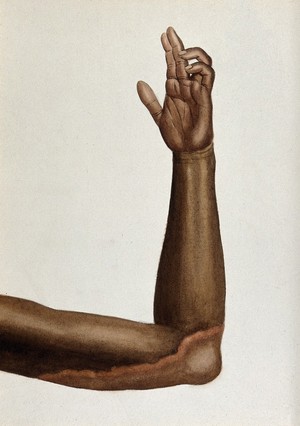 view Leprosy: a red patch on an Indian man's arm causing two fingers to bend. Watercolour (by Jane Jackson?), 1921/1950 (?), after Ernest Muir, ca. 1921.