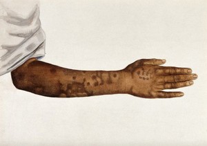 view Leprosy: skin discolouration on an Indian man's arm. Watercolour (by Jane Jackson ?), 1921/1950 (?), after a (painting ?) by Ernest Muir, ca. 1921.