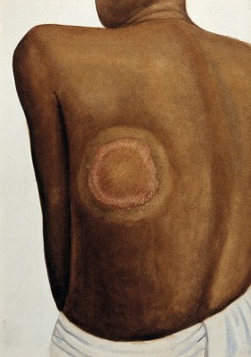 Leprosy: circular skin lesion on the back of an Indian patient. Watercolour (by Jane Jackson?), 1921/1950 (?), after Ernest Muir, ca. 1921.