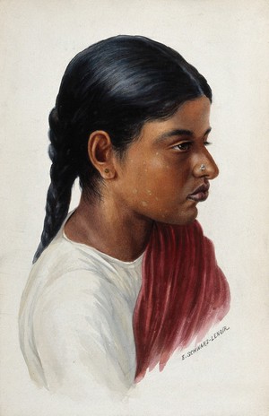 view Leprosy: a red patch on an Indian girl's face: a head and shoulders portrait in profile. Watercolour by E. Schwarz-Lenoir, 1920/1950 (?) after C. Donovan.