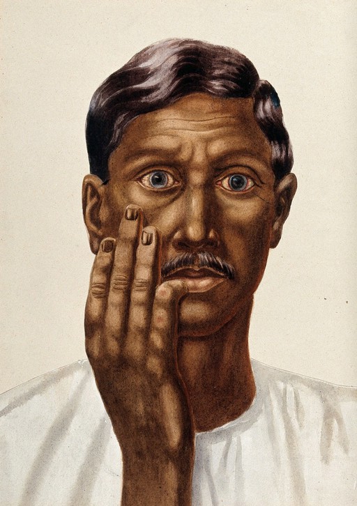 Leprosy of the skin: an Indian man holds up an infected hand to his face. Watercolour (by Jane Jackson ?), 1921/1950 (?), after an original (painting ?) by Ernest Muir, ca. 1921.