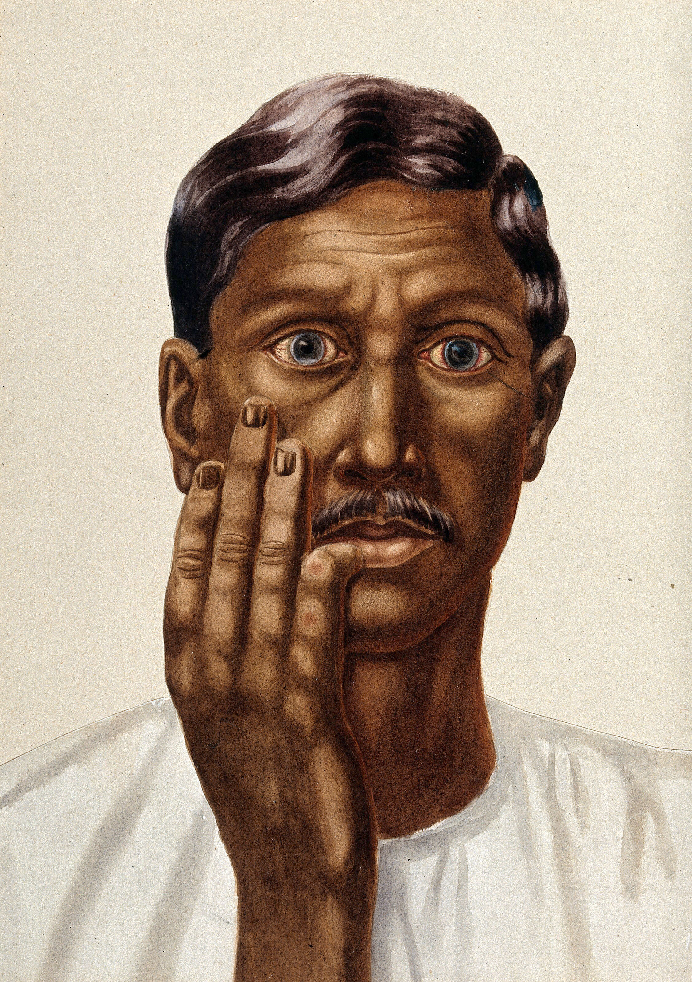 Leprosy Of The Skin An Indian Man Holds Up An Infected Hand To