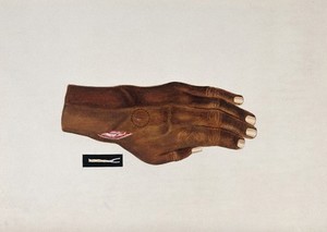 view Nerve leprosy: a small lesion on a patient's hand; insert shows detail of the infected nerve. Watercolour (by Jane Jackson?), 1921/1950 (?), after Ernest Muir, ca. 1921.