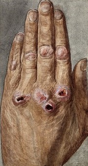 Elephantiasis (lymphatic filariasis): red lesions on a patient's hand. Watercolour, 1920/1950 (?).