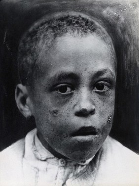 Leprosy: nodules on a boy's face: a head and shoulders portrait. Photograph, 1870/1910.